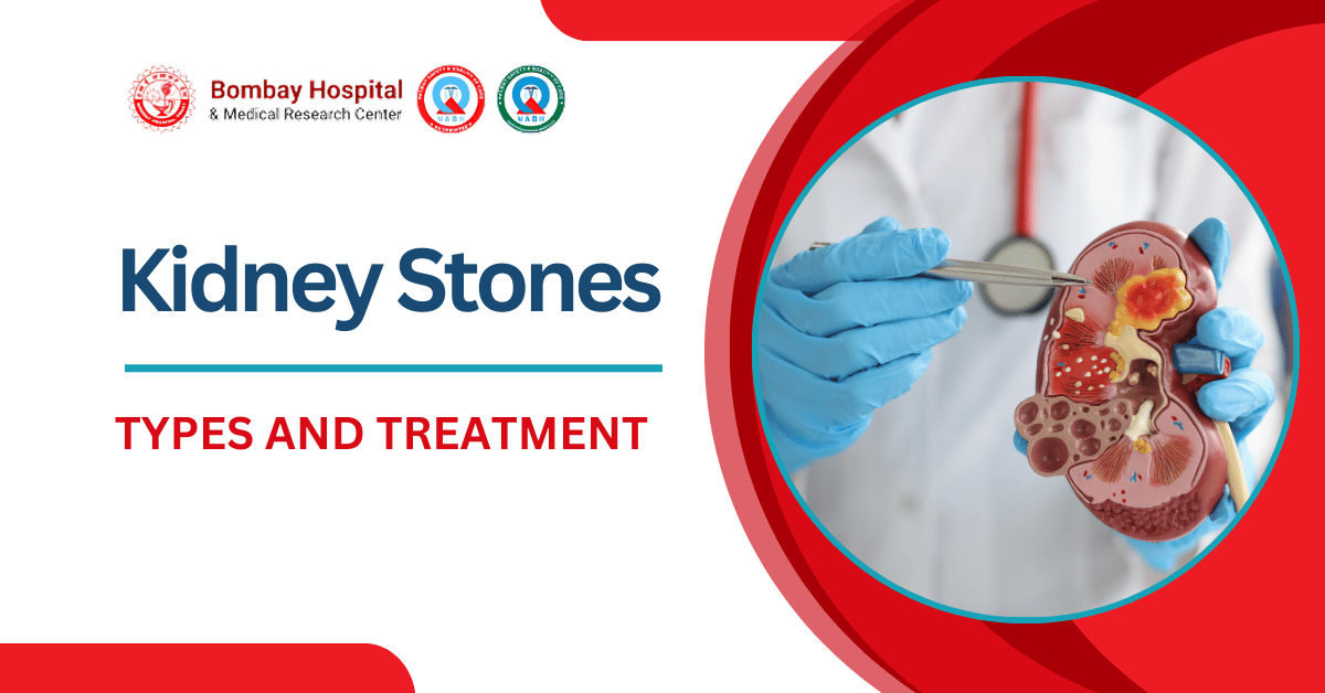 Types of kidney stones and treatment illustration